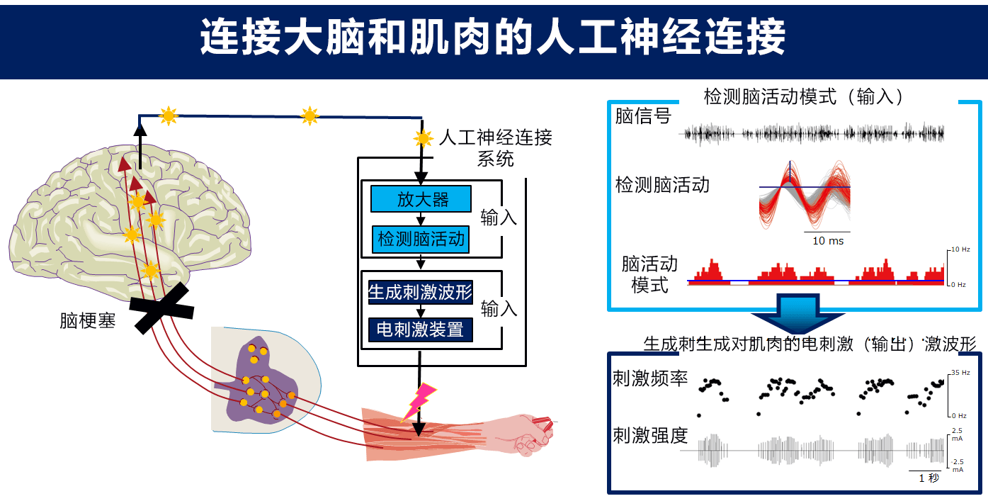 人工神經連接系統讓腦梗塞患者重拾手部運動功能