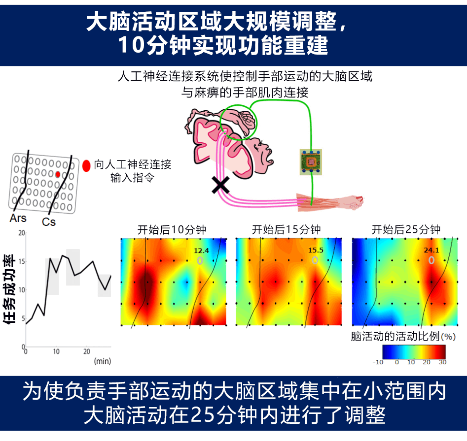 人工神經連接系統讓腦梗塞患者重拾手部運動功能