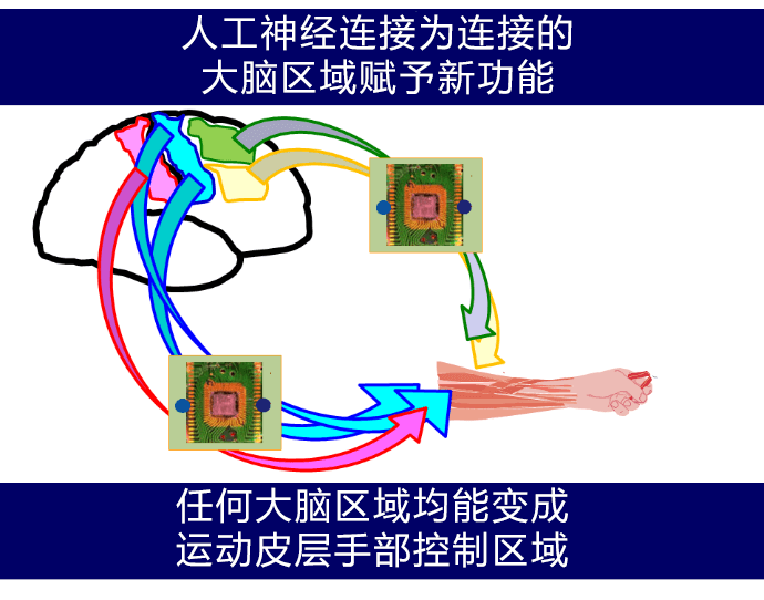 人工神經連接系統讓腦梗塞患者重拾手部運動功能