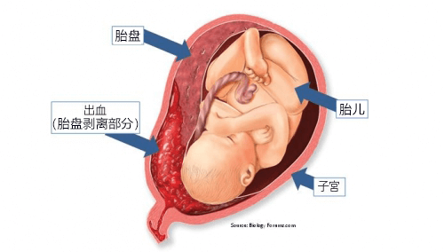 沙塵天氣或引發胎盤早剝