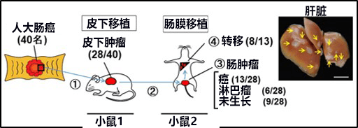 日本查明大腸癌的新轉移機制，將開發以癌細胞羣爲靶點的大腸癌轉移抑制療法