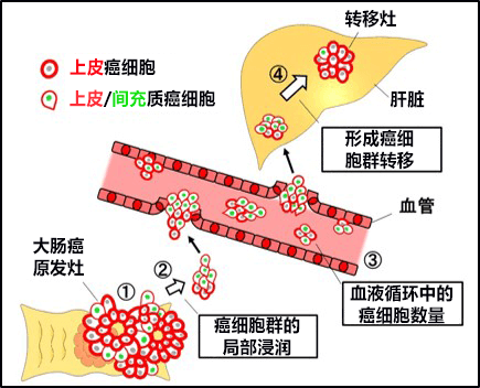 日本查明大腸癌的新轉移機制，將開發以癌細胞羣爲靶點的大腸癌轉移抑制療法