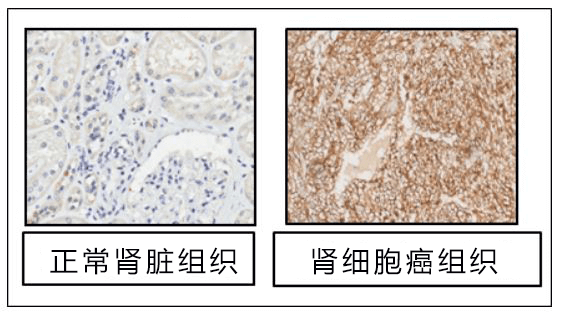 千葉大學發現腎癌新靶點，助力新藥開發