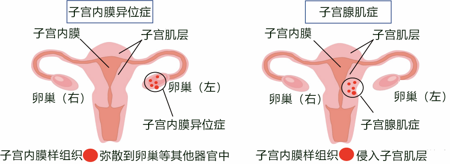 日本發現導致子宮腺肌症發病及併發子宮內膜異位症的基因突變