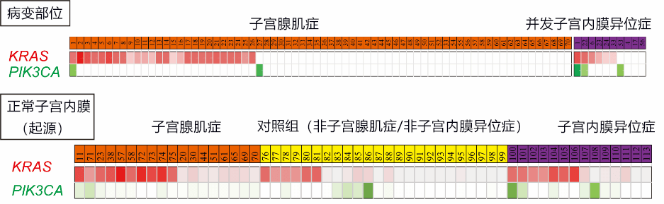 日本發現導致子宮腺肌症發病及併發子宮內膜異位症的基因突變