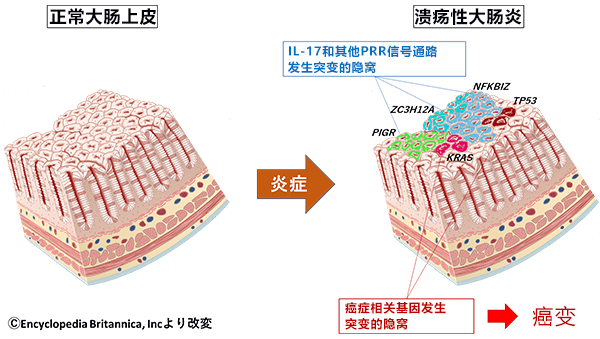 日本查清潰瘍性大腸炎的上皮重塑機制與癌變的關係