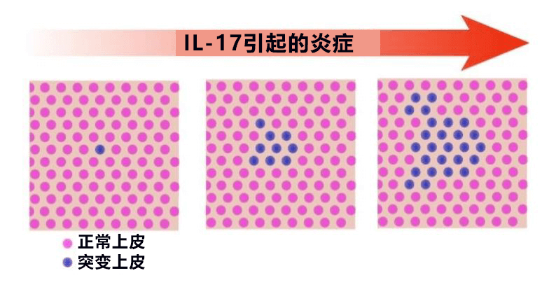 日本發現潰瘍性大腸炎特定基因突變，有望查清發病和惡化機制