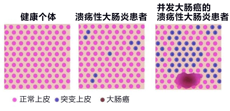 日本發現潰瘍性大腸炎特定基因突變，有望查清發病和惡化機制