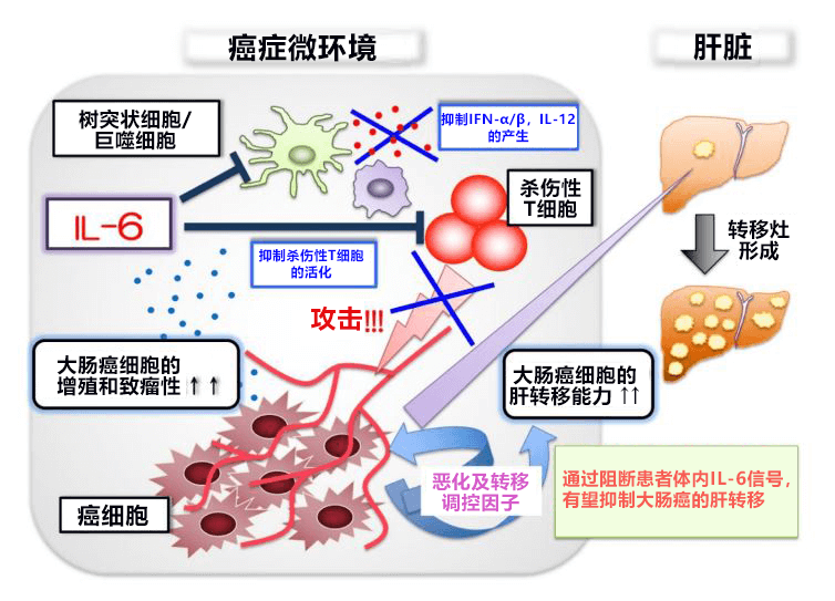 日本查清促進大腸癌肝轉移的新控制機制，阻斷IL-6訊號有望抑制轉移