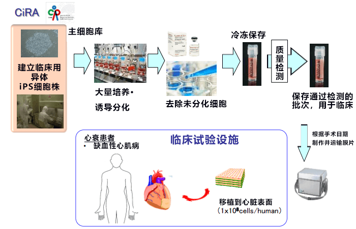 大阪大學成功移植iPS細胞心肌片至患者心臟