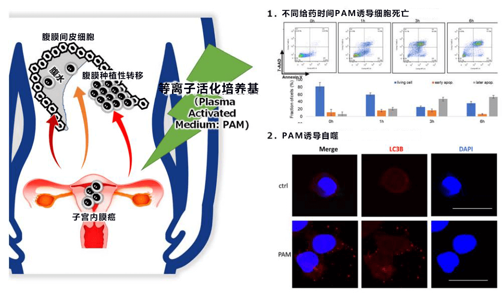 開拓子宮內膜癌冶癒的新思路――電漿抗腫瘤的效果和機制