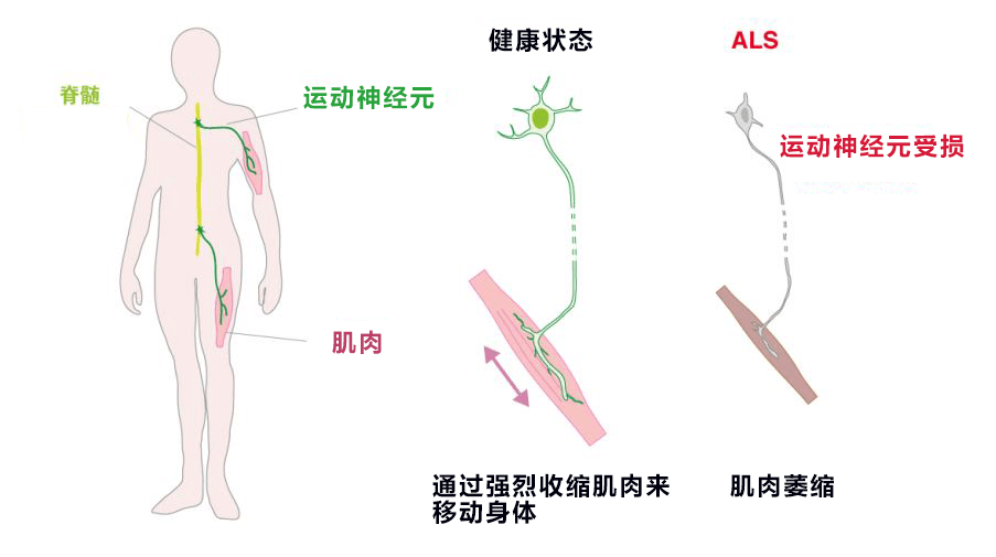 用光照射再現漸凍症，有望查清發病機制並開發新藥