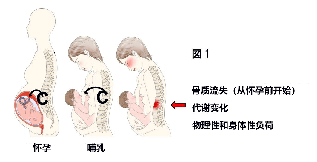 孕前檢查骨密度，有益於預防產後骨質疏鬆和椎體骨折